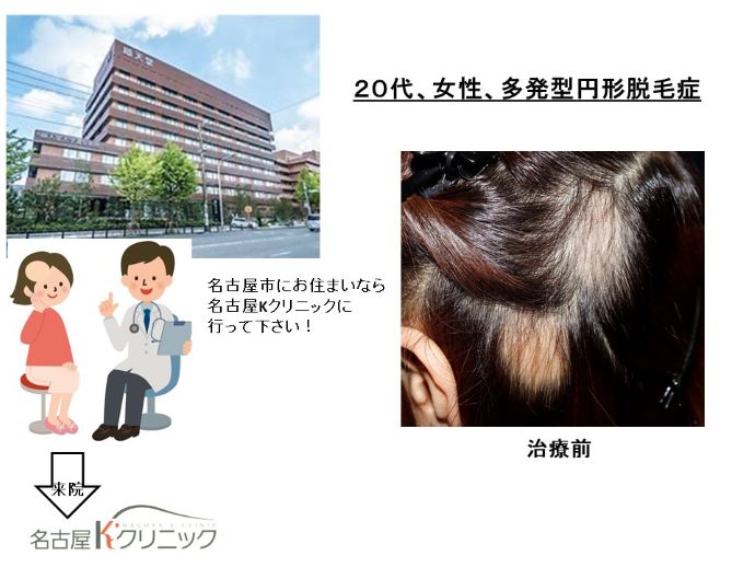 円形脱毛症　病院